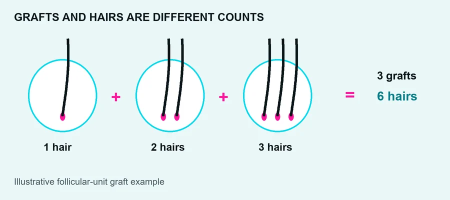 Hair transplant grafts versus hairs diagram: three follicular-unit grafts containing one, two and three hairs, totaling six hairs