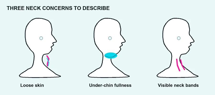 Neck lift concerns diagram highlighting loose skin, under-chin fullness and visible neck bands on three illustrative neck profiles