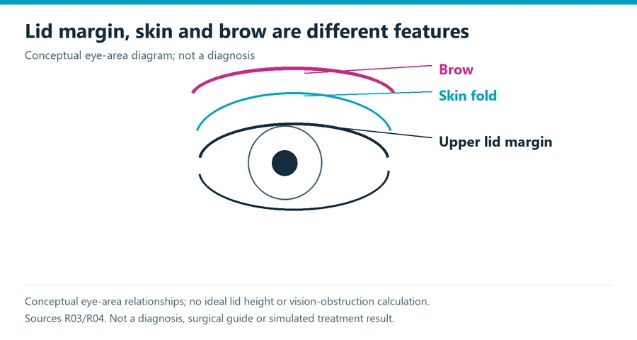 Ptosis surgery anatomy explanation distinguishes the upper eyelid margin, excess eyelid skin and brow position around a simplified eye; conceptualfeatures, not a diagnosis or simulated result